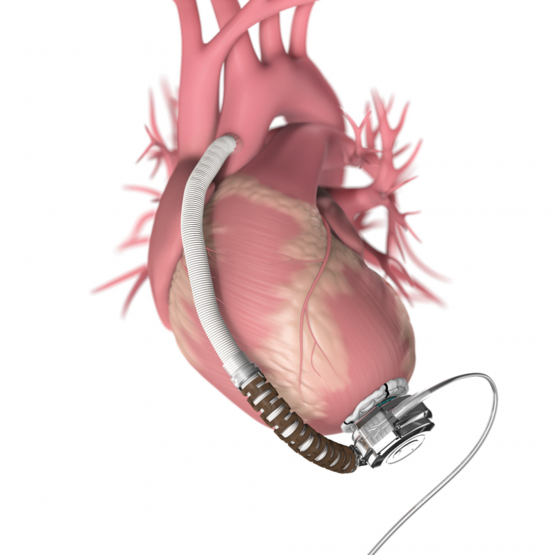 10 let od první implantace mechanické srdeční podpory v CKTCH